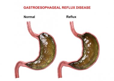 Gastroesophageal Reflux Disease - failure of the digestive mechanism (sphincter) that causes passage of gastric acid into the esophagus clipart
