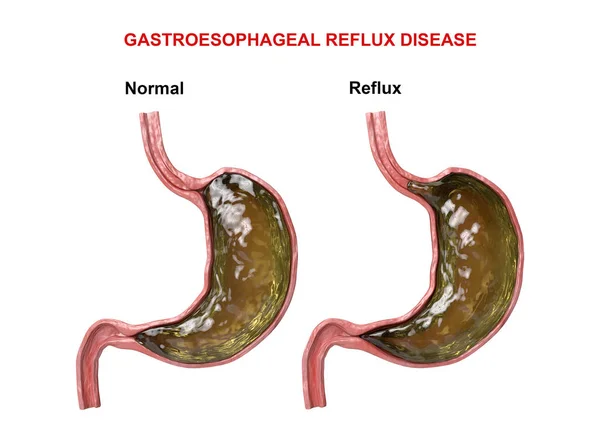 Doença de refluxo gastroesofágico - falha do mecanismo digestivo (esfíncter) que causa a passagem de ácido gástrico para o esôfago — Fotografia de Stock