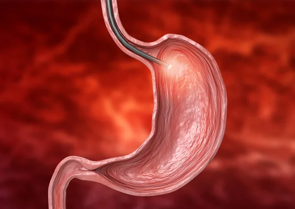 Endoscopia digestiva - exame usando tubo flexível com câmera e luz no seu final para diagnóstico de doenças do sistema digestivo — Fotografia de Stock