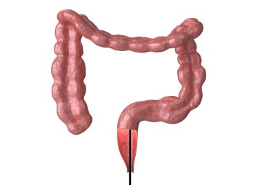 colonoscopy - is the endoscopic examination of the large intestine and rectum that helps in the discovery of bowel cancer clipart