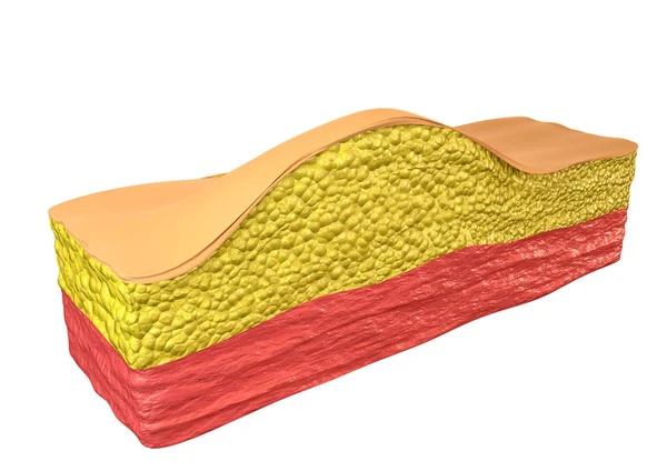 Lipome - tumeur bénigne composée de cellules adipeuses (adipocytes), qui s'accumulent à l'intérieur d'une capsule fibreuse juste en dessous de la peau dans le tissu sous-cutané — Photo