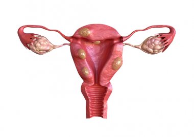 uterin fibroid kas dokusu tarafından oluşturulan benign solid tümörlerdir. Büyüklüğü büyük ölçüde değişebilir ve bazı neden büyük karın artışı