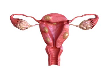uterine fibroid are benign solid tumors formed by muscle tissue. Its size can vary greatly and some cause large abdomen increase clipart