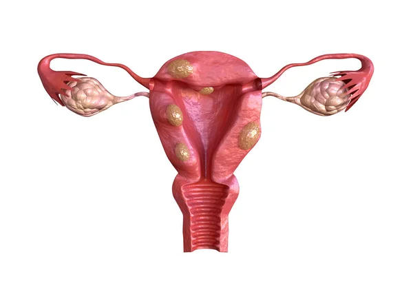 Uterinové fibroid jsou neškodné pevné nádory tvořené svalovou tkání. Jeho velikost se může značně lišit a některé způsobují velké zvýšení břicha — Stock fotografie