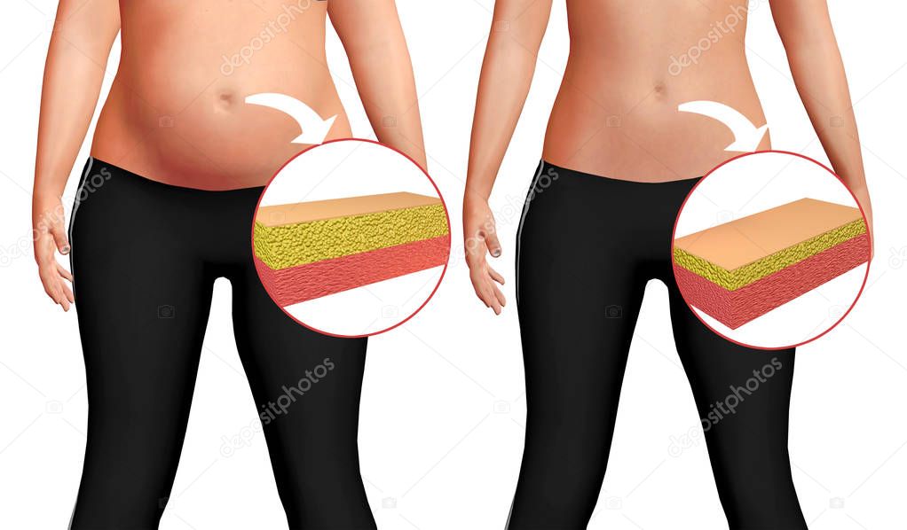 Female body before and after liposuction on white background. Concept of health care and weight loss