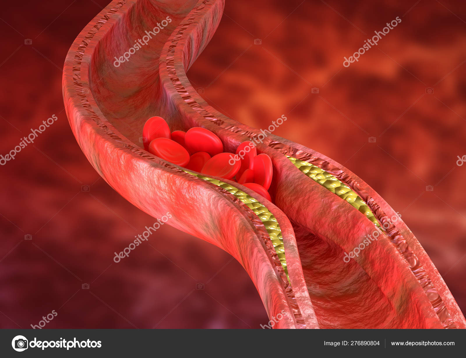 Atherosclerosis is an accumulation of cholesterol plaques in the walls of the arteries, which