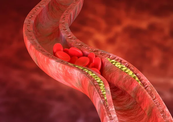 La aterosclerosis es una acumulación de placas de colesterol en las paredes de las arterias, que causa obstrucción del flujo sanguíneo . — Foto de Stock