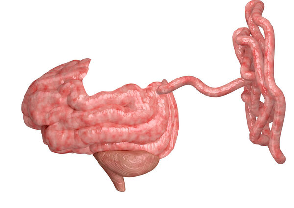 Parkinson's disease is a degenerative disease of the neurological system that affects the brain, impairs motor coordination and causes tremors