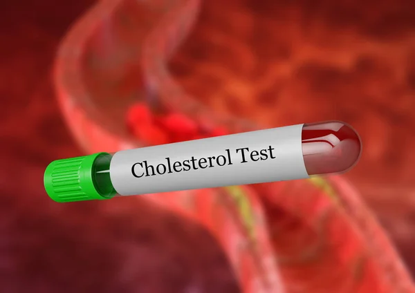 Bloedmonster in reageerbuis voor laboratorium cholesterol test. — Stockfoto