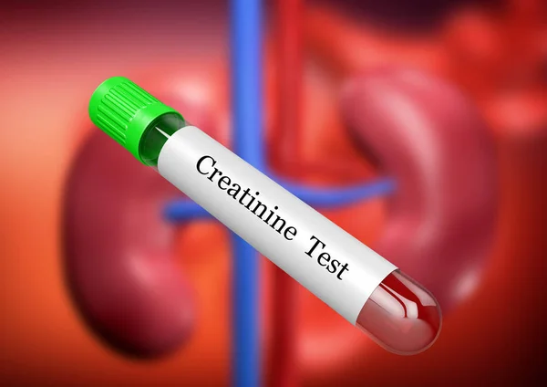 Laboratuvar kreatinin incelemesi için test tüpündeki kan örneği.