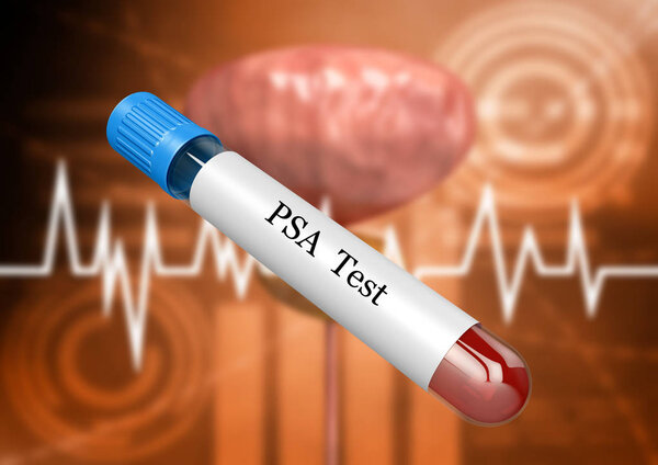 Blood sample in laboratory test tube for PSA examination for detection of prostate disorders and diseases