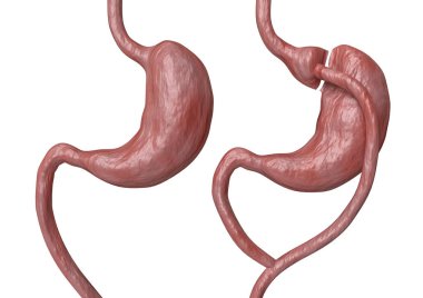 Gastric bypass is a type of bariatric surgery that consists of reducing the stomach and altering the bowel, leading to a marked loss of body weight clipart
