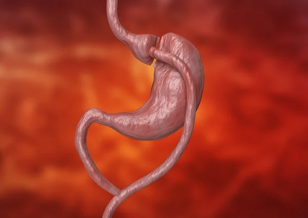 El bypass gástrico es un tipo de cirugía bariátrica que consiste en reducir el estómago y alterar el intestino, lo que conduce a una marcada pérdida de peso corporal. — Foto de Stock