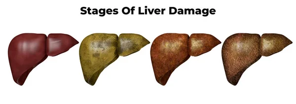 Stages of liver damage. The first symptoms of liver problems are abdominal pain, swollen belly, yellow skin and eyes, dark urine — Stock Photo, Image