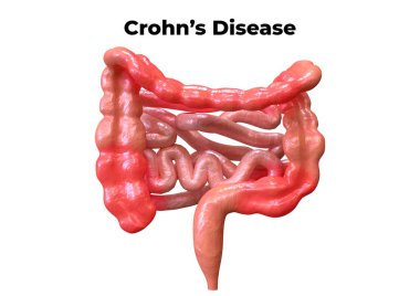 Crohn's disease is a syndrome that affects the digestive system. Its symptoms are abdominal pain associated with diarrhea, fever, weight loss and weakening. clipart