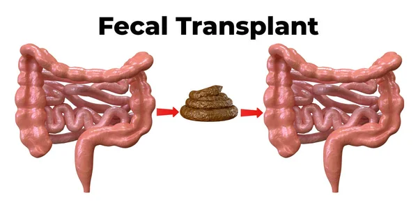 Fecal Microbiota transplantation是一种将捐献者的排泄物放入肠道炎症患者肠道的方法. — 图库照片