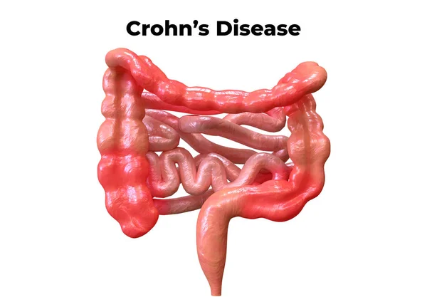 La enfermedad de Crohn es un síndrome que afecta al sistema digestivo. Sus síntomas son dolor abdominal asociado con diarrea, fiebre, pérdida de peso y debilitamiento . — Foto de Stock