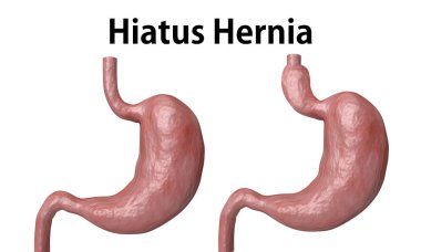 The hiatal hernia is the advancement of part of the stomach towards the esophagus, isolated over white background clipart