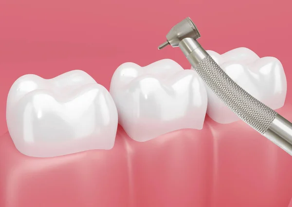 Zub Pacienta Ošetřený Zubním Vrtákem Odstranění Dutin Vykreslování — Stock fotografie
