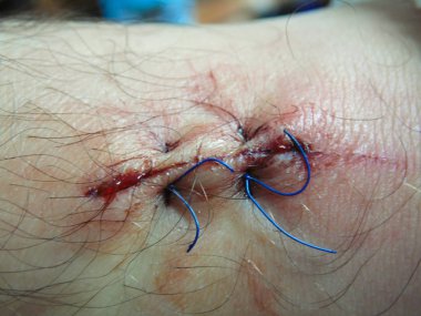 dikişli bacak yarası. makro iki dikişleri