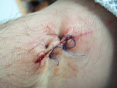 stitched leg wound. macro two seams clipart