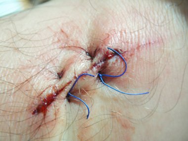 dikişli bacak yarası. makro iki dikişleri