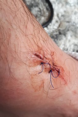 bacağına dikiş. Hemen önce bölünmüş bir bacak.