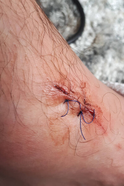 Швы на ноге. Раздробленная нога
.