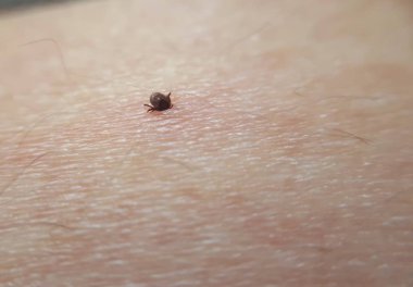 Tick Ixodes ricinus insan derisinde. İnsan elinin üzerinde gezinen kene. Ensefalit kenesi.