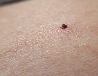 Tick Ixodes ricinus insan derisinde. İnsan elinin üzerinde gezinen kene. Ensefalit kenesi.