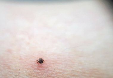 Tick Ixodes ricinus insan derisinde. İnsan elinin üzerinde gezinen kene. Ensefalit kenesi.