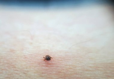 Tick Ixodes ricinus insan derisinde. İnsan elinin üzerinde gezinen kene. Ensefalit kenesi.