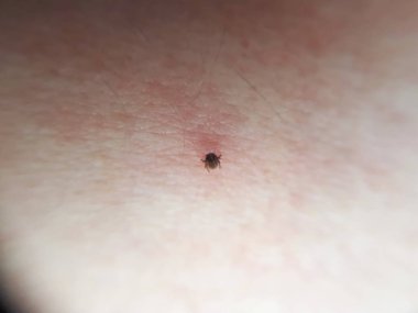 kene emme, ixodes ricinus, bir insan emme