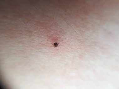 kene emme, ixodes ricinus, bir insan emme