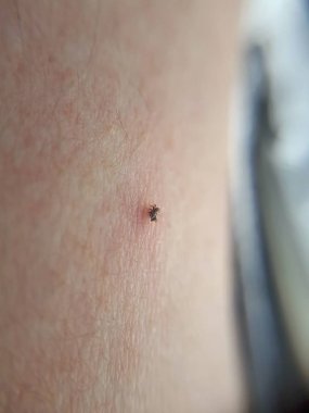 kene emme, ixodes ricinus, bir insan emme