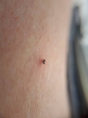 kene emme, ixodes ricinus, bir insan emme