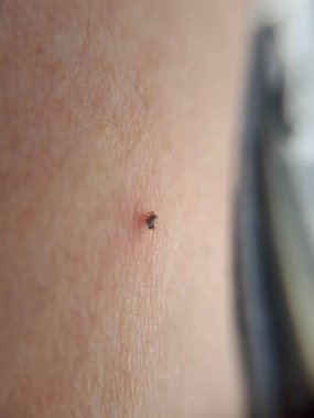 Veba keneler. Lyme hastalığı ve menenjit