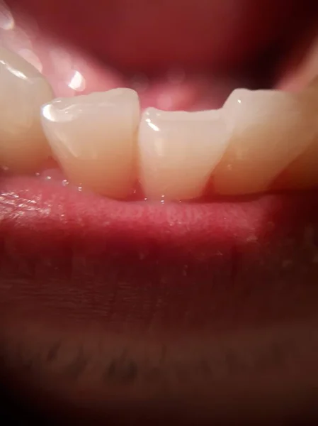 毛があり 開いた口が不均一な黄色い歯を持つ男 — ストック写真
