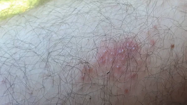 Καμένο Δέρμα Ανθρώπινο Πόδι Πολλές Τρίχες — Φωτογραφία Αρχείου