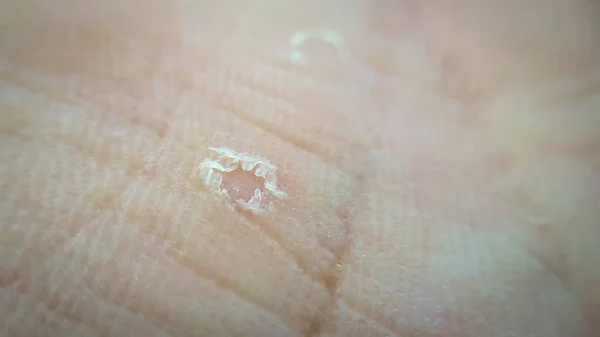 Makro Manusia Kulit Tidak Sehat Permukaan Dermatologi Kulit Kaukasia Dengan — Stok Foto