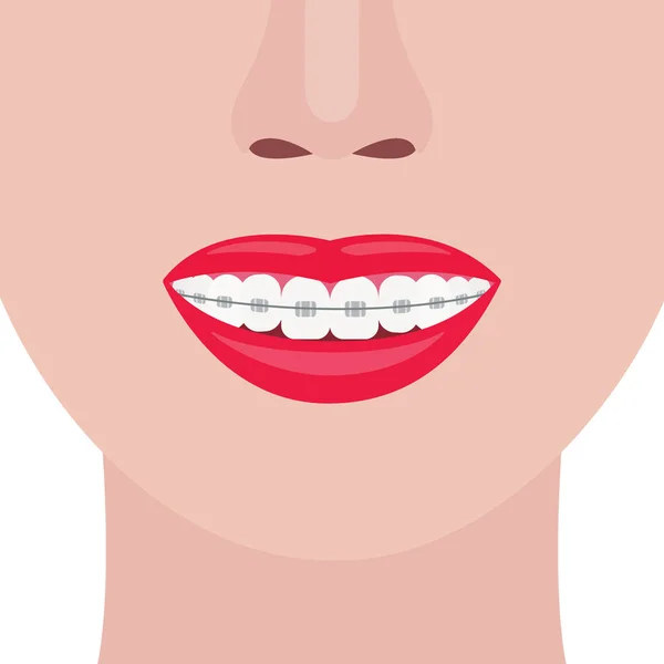 Hermosa sonrisa femenina con frenos estéticos. Corrección dental. Ilustración vectorial — Vector de stock