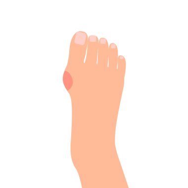 Hallux valgus deformasyon kemikleri insan bacağındaki ayak iskeleti, nasır hastalığı. Romatoid eklem iltihabı. Kırmızı acılı bölge ayak parmağı eklemleri. Tıbbi konsept. Vektör