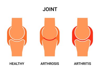 İnsan eklemi, sağlıklı, atritis ve artrosis. Eklem ağrısı, kıkırdak aşınması, eklem kapsülünde iltihap. Vektör illüstrasyonu