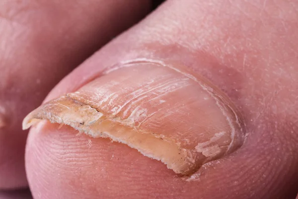 stock image Nail fungus on legs. Close-up on a white background.