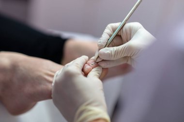 Profesyonel pedicurist koruyucu eldiven giymiş tıbbi pedikür yapım closeup.