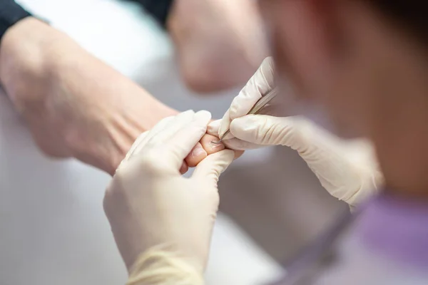 Podologen entfernen Nagelhaut aus einem Zehennagel — Stockfoto