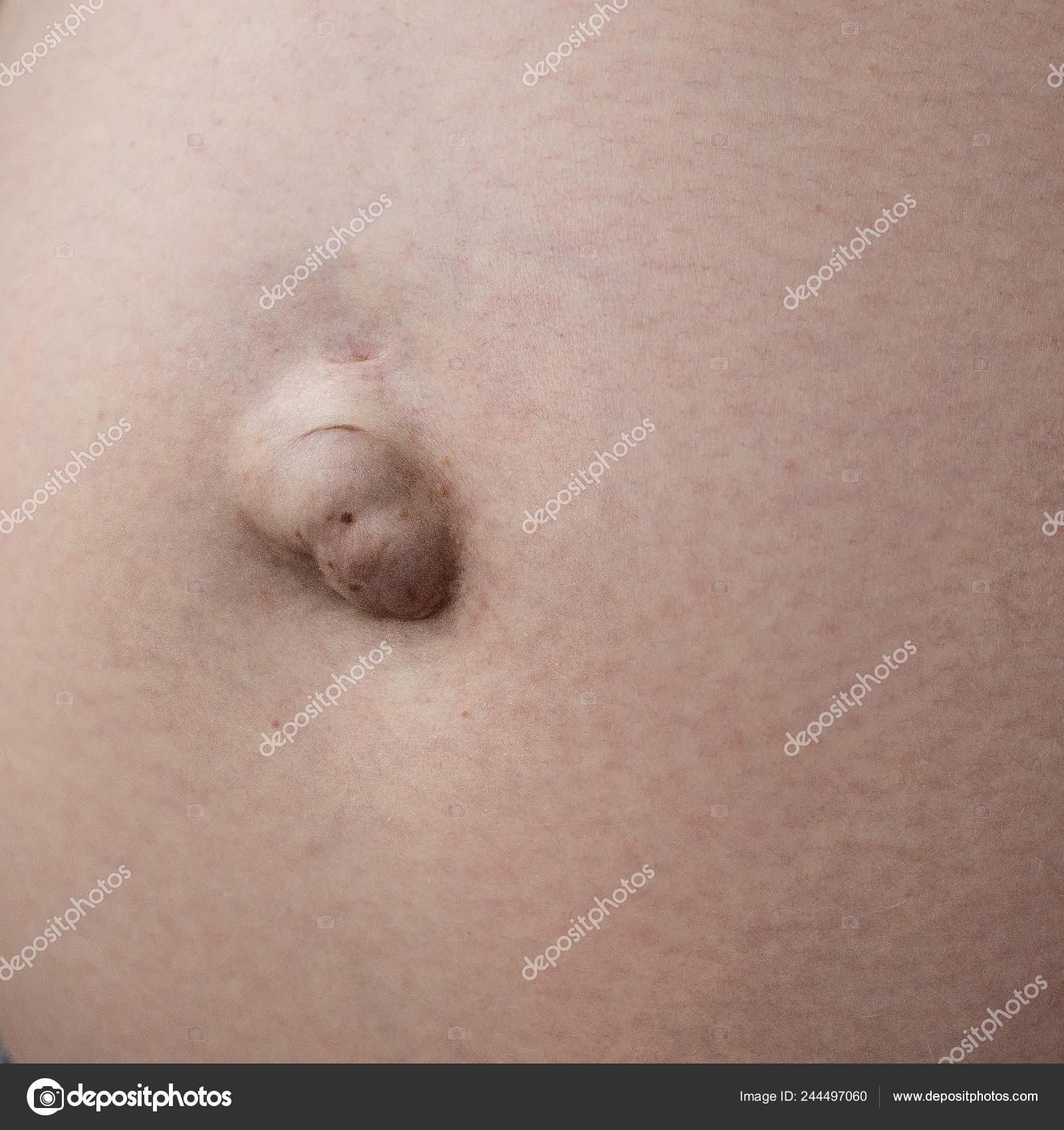 Hernia umbilical en una mujer embarazada. Primer plano