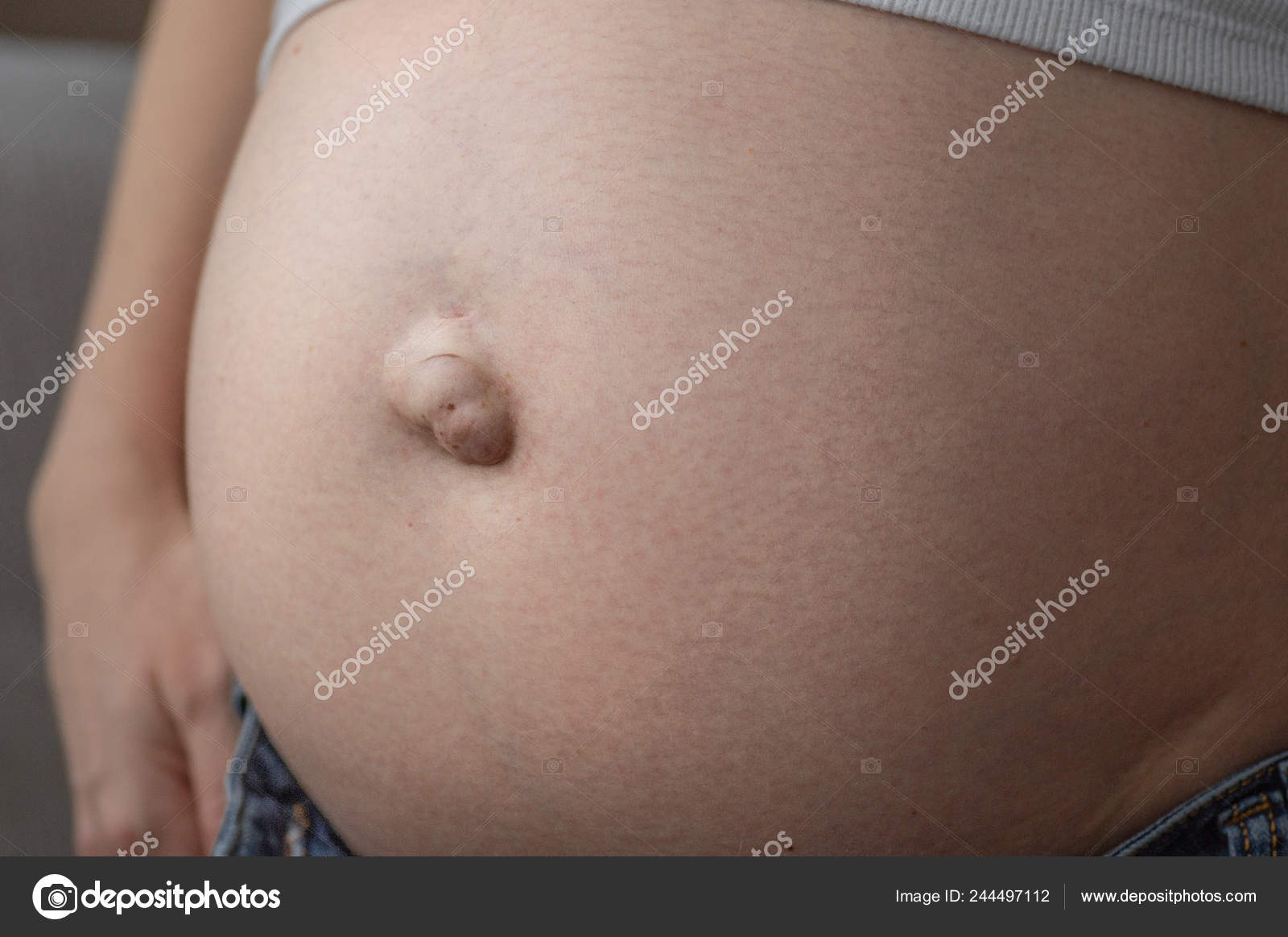 Hernia umbilical en una mujer embarazada. Primer plano