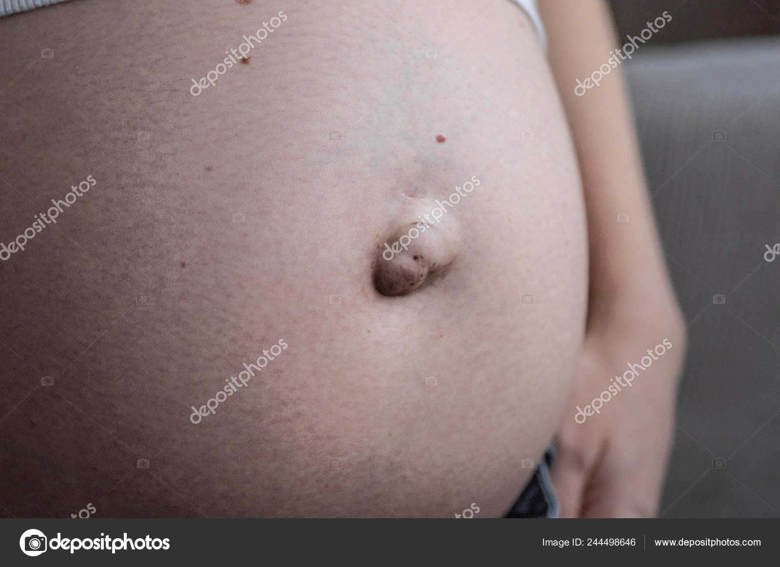 Hérnia umbilical numa mulher grávida. Fechar. fotos, imagens de