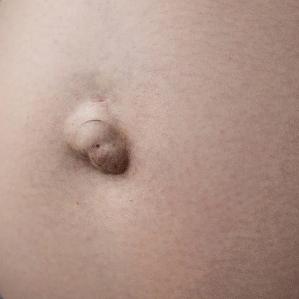 Umbilical hernia in a pregnant woman. Closeup — Stock Photo, Image